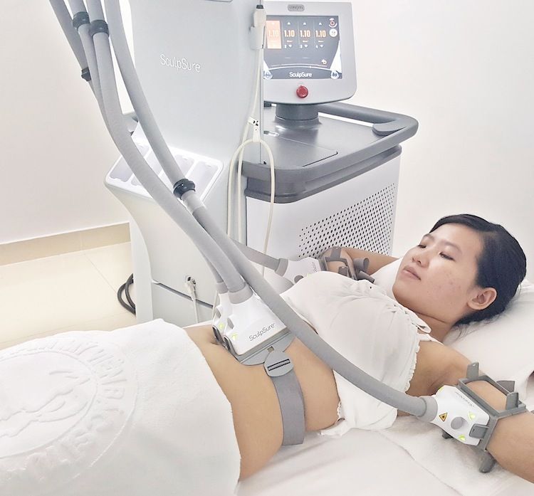 hút mỡ bằng Laser SculpSure có hiệu quả không