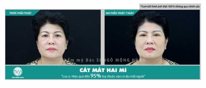 Cắt mí mắt kiêng ăn gì