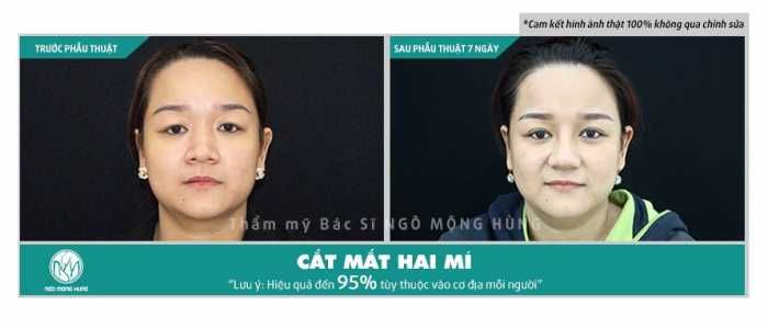 Cắt mí mắt kiêng ăn gì