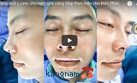Nâng mũi L-Line cho nam – Mũi đẹp chuẩn men – Cận cảnh kết quả - Thẩm mỹ Kangnam