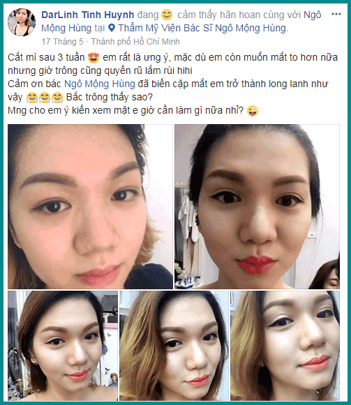 Cắt mí mắt kiêng ăn gì