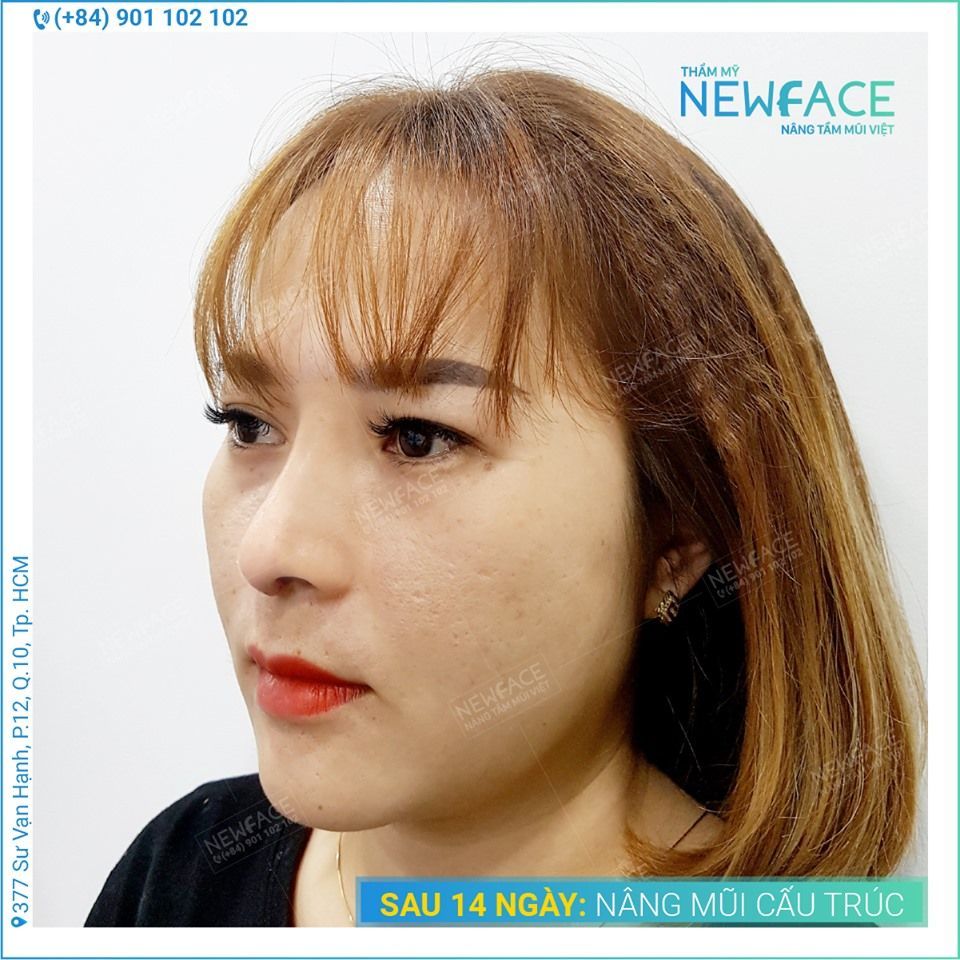 nang-mui-ngan-gay-bs-tran-phuong