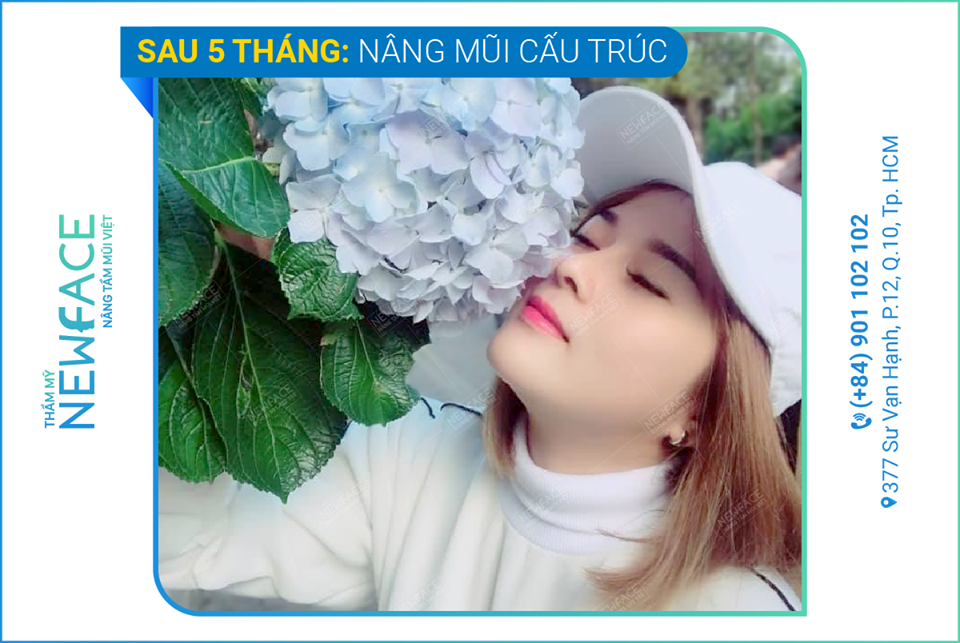 Giải pháp cho nàng mũi gãy, ngắn - Bs Trần Phương