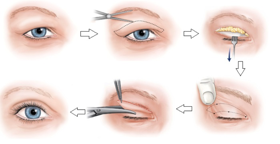 Phẫu thuật mắt hai mí là giải pháp tuyệt vời cho những người muốn sở hữu ánh nhìn sắc nét và quyến rũ hơn. Hãy xem hình ảnh liên quan đến từ khóa này để tìm hiểu thêm về quá trình phẫu thuật và kết quả sau đó.