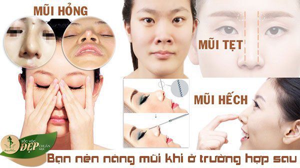 Nâng mũi Sline để cải thiện đầu mũi thấp - Bs Nguyễn Thanh Vân