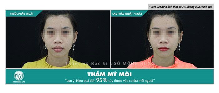 Phẫu thuật môi trề