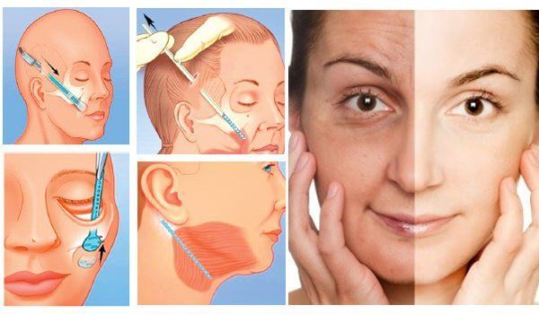 Phương pháp căng da mặt: Phẫu thuật và không phẫu thuật -  Bs Nguyễn Thanh Vân