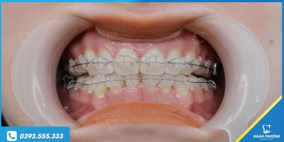 Hàm răng đẹp, trắng, và đều chính là mong muốn lớn của những người gặp các khuyết điểm lớn về Răng.