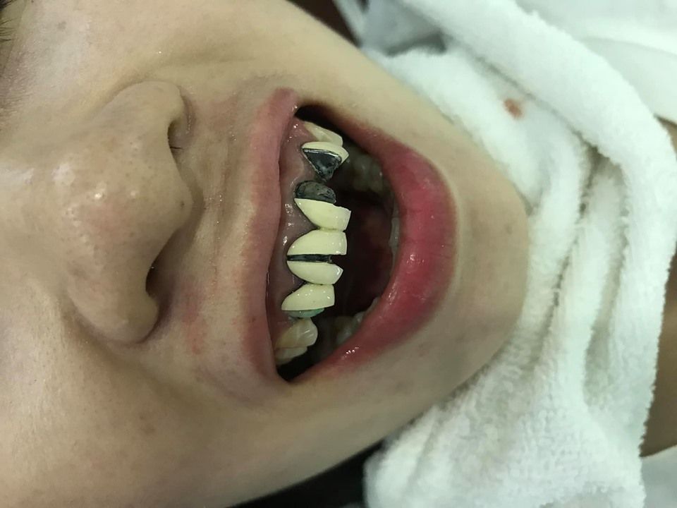 Hậu quả khôn lường khi làm răng giá rẻ, kĩ thuật kém