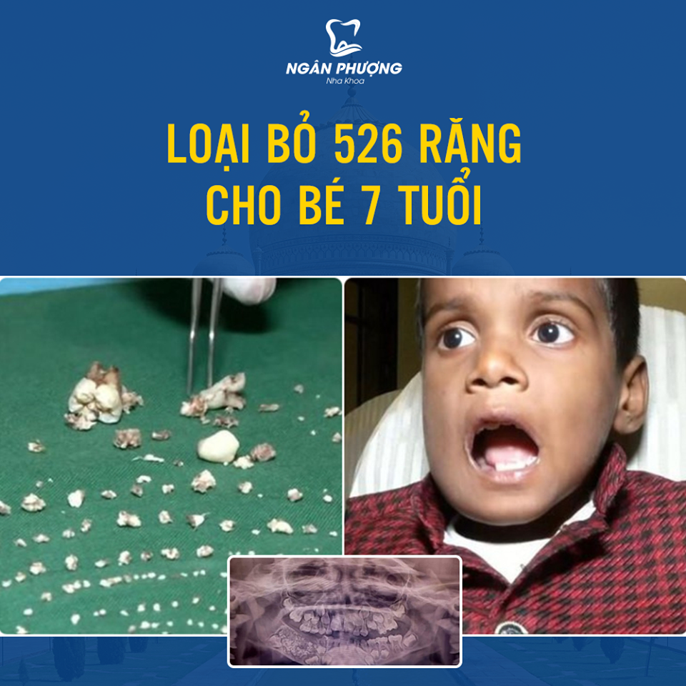 Mất tới 5 giờ loại bỏ 526 chiếc răng cho cậu bé 7 tuổi người Ấn Độ.