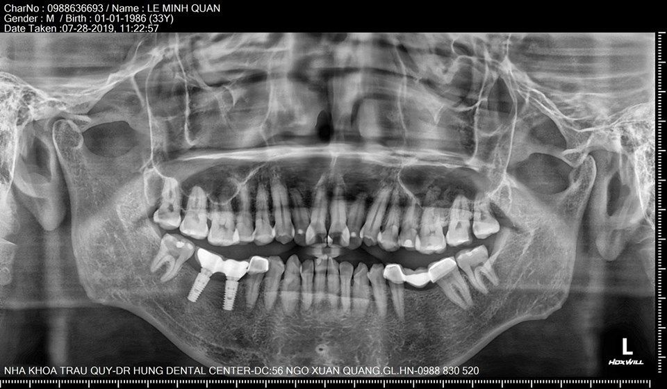 CHUYÊN MỤC TÁI KHÁM IMPLANT SAU 6 NĂM