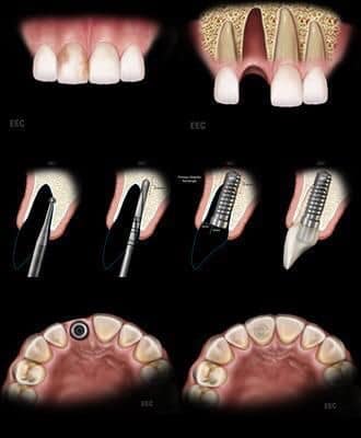 Implant Nha Khoa- Phương pháp thay thế răng mất hoàn hảo nhất