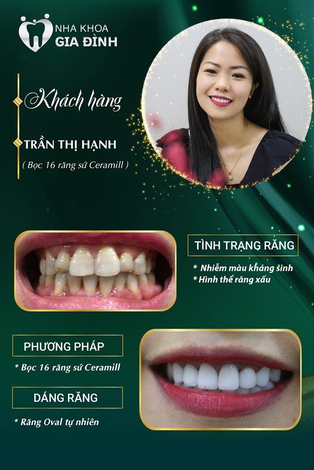 Chị Hạnh (chủ shop quần áo) đã thêm phần xinh đẹp, duyên dáng sau khi được "phù phép" răng bằng giải pháp thẩm mỹ răng sứ cao cấp tại Nha khoa Gia Đình.