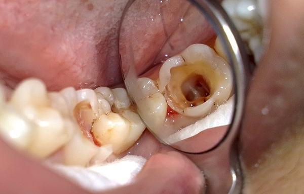 Ở Việt Nam, có hơn 75% người dân bị răng sâu và phần lớn không được điều trị từ sớm.