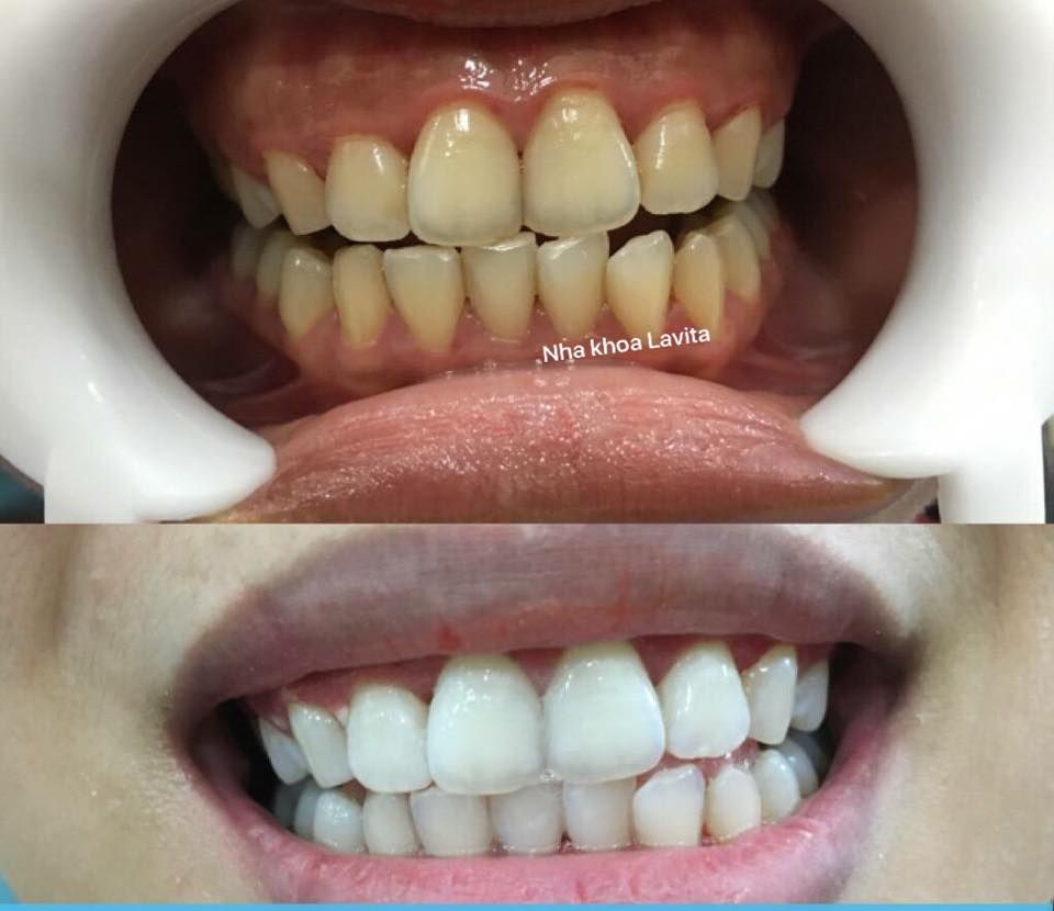Không phải cứ răng ố vàng là cần làm răng sứ, mà chỉ cần 60 phút TẨY TRẮNG RĂNG tại phòng khám là bạn đã có thể lấy lại hàm răng trắng sáng như ý rồi