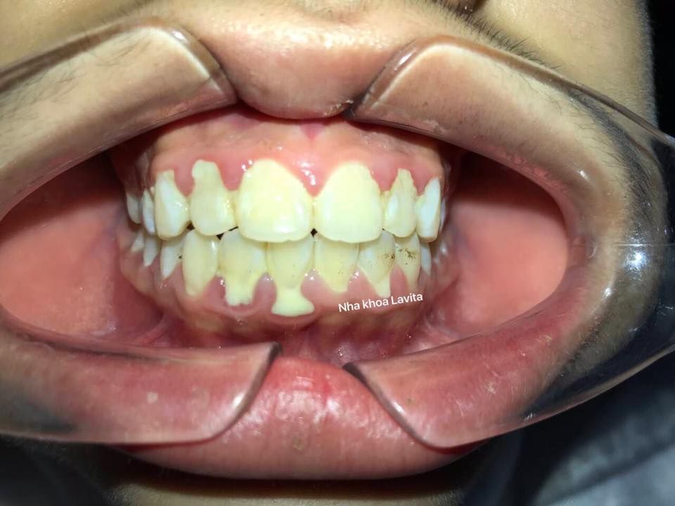 Cao răng, mảng bám không chỉ gây mất thẩm mỹ cho hàm răng, nụ cười mà còn là khởi nguồn của rất nhiều bệnh lý răng miệng nguy hiểm.