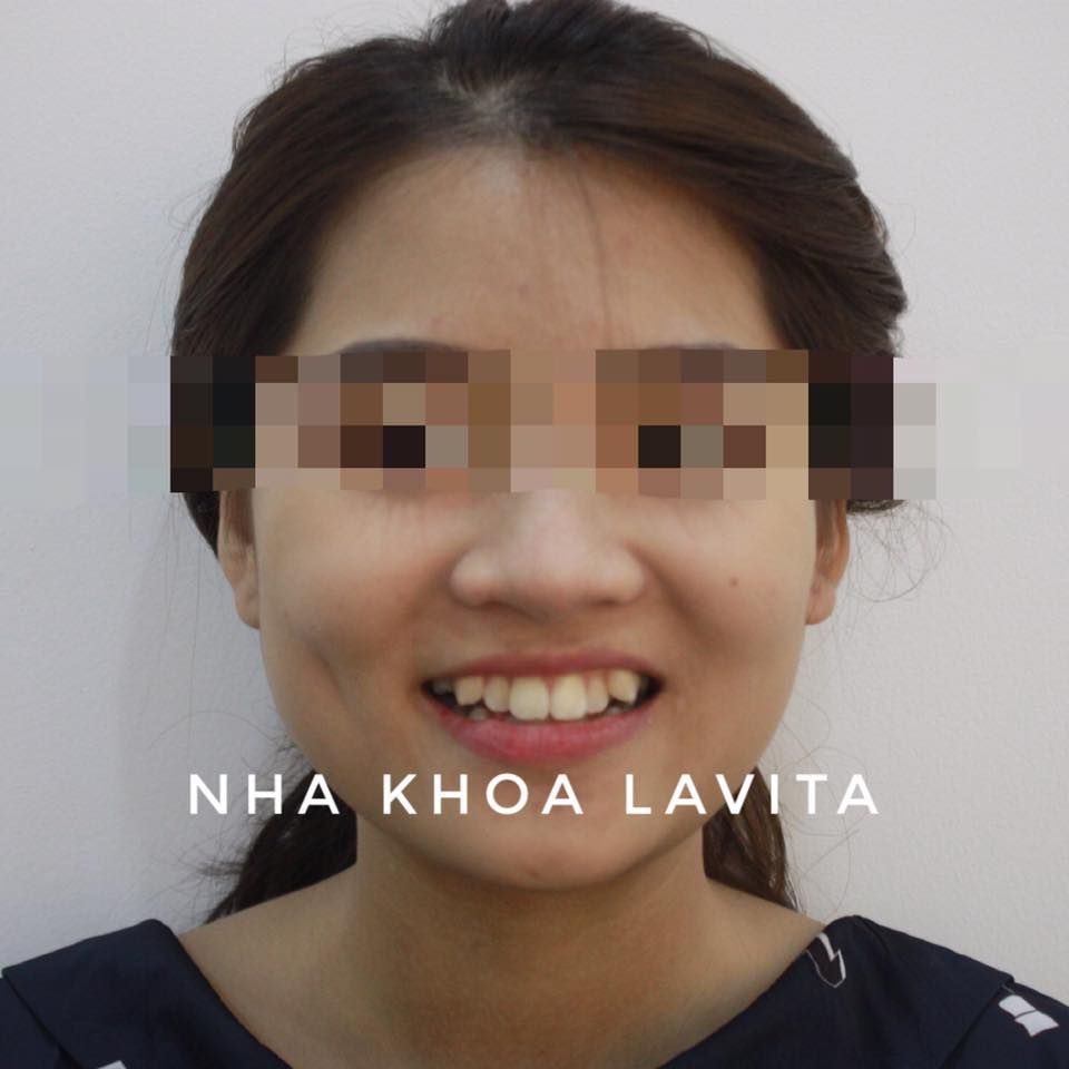 Bệnh nhân chỉnh nha: Quỳnh Anh