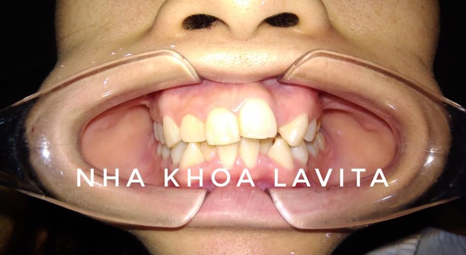 Chúc mừng khách hàng Như Quỳnh vừa hoàn thành xong quá trình niềng răng tại NhakhoaLavita.