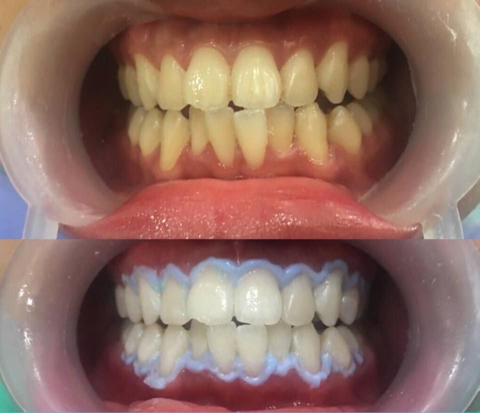 Hình ảnh ca tẩy trắng răng vừa được thực hiện tại Nha khoa Lavita
