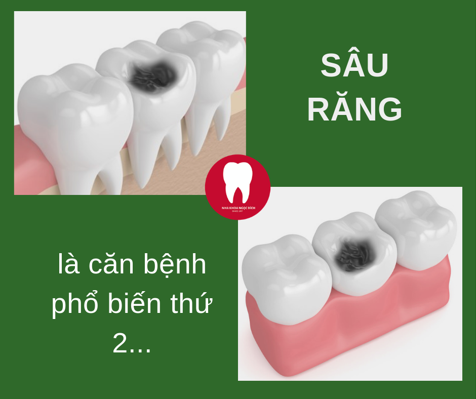 BẠN CÓ BIẾT Sâu răng chính là căn bệnh phổ biến thứ 2 trong các loại bệnh