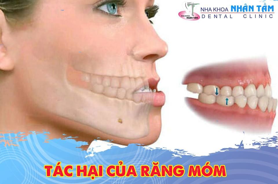 RĂNG MÓM VÀ NHỮNG ẢNH HƯỞNG NGHIÊM TRỌNG ĐẾN SỨC KHỎE CƠ THỂ
