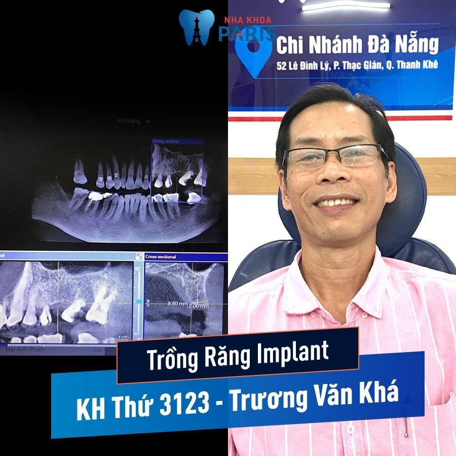 KH TRỒNG RĂNG IMPLANT THỨ 3123 TRONG THÁNG 8 - Trương Văn Khá (Đà Nẵng