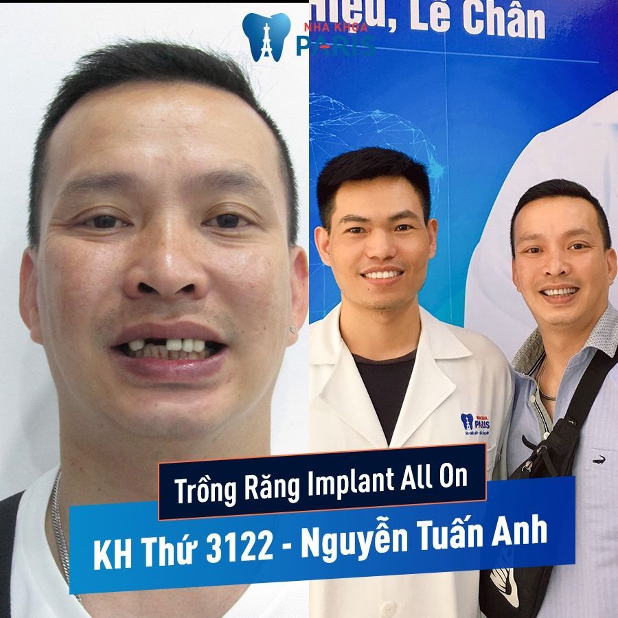 KH TRỒNG RĂNG IMPLANT THỨ 3122 TRONG THÁNG 8 - Nguyễn Tuấn Anh (Hải Phòng)