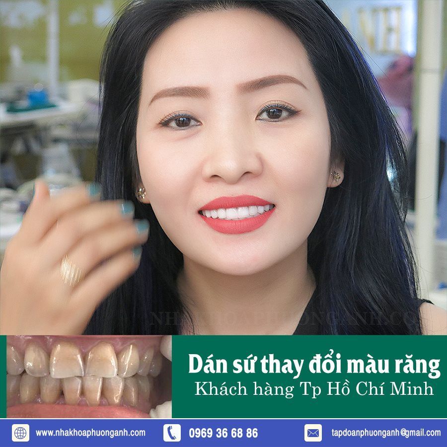 Hình ảnh đẹp cuối ngày Dán Răng Sứ, phương pháp xâm lấn ít nhất