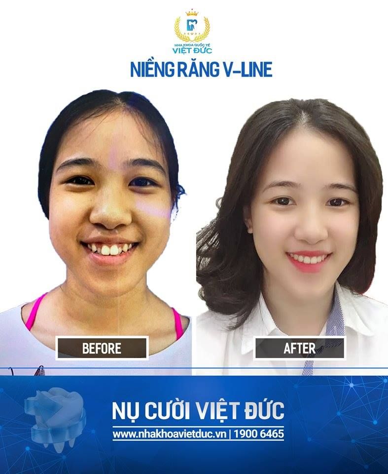 Chào tuần mới với nụ cười xinh tự tin, rạng rỡ của khách hàng nha khoa Quốc tế Việt Đức