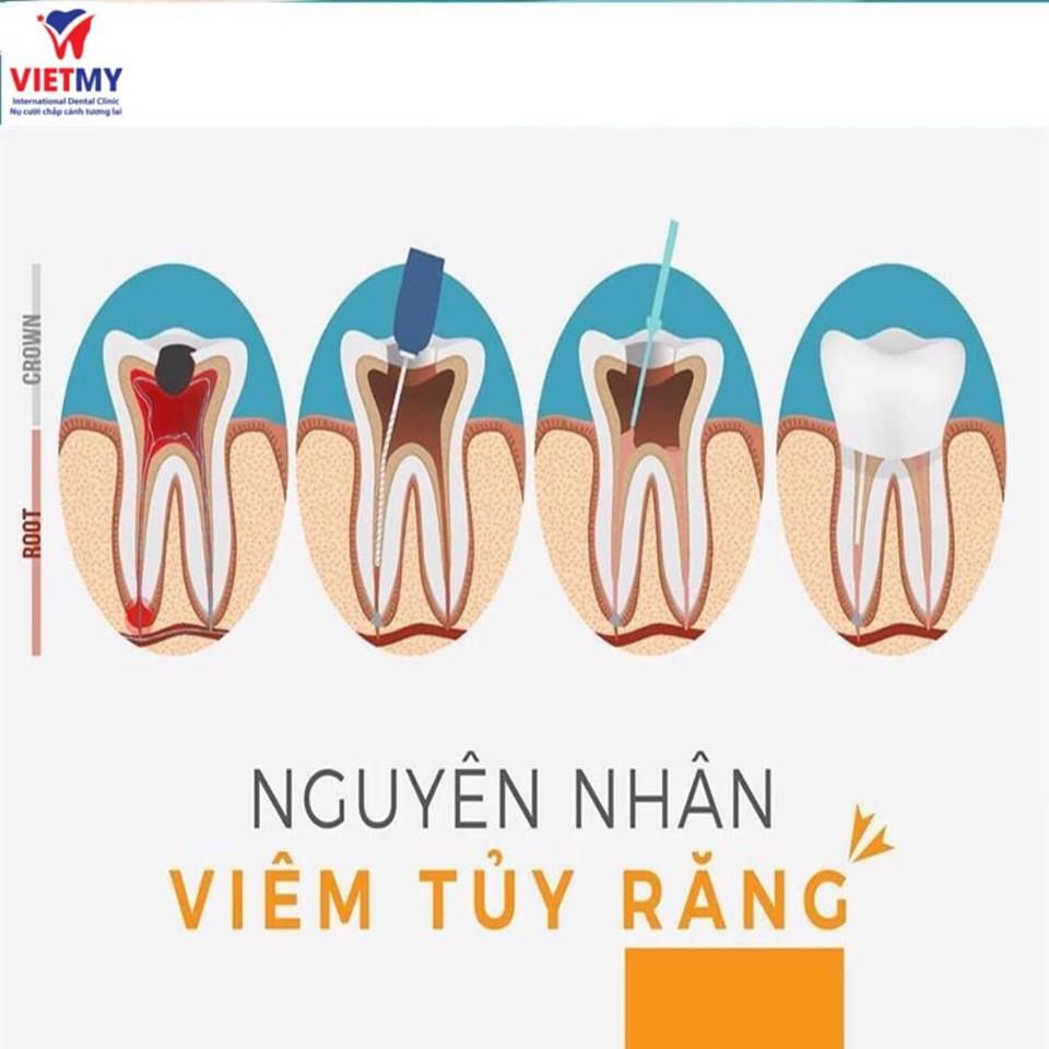 NGUYÊN NHÂN VIÊM TỦY RĂNG