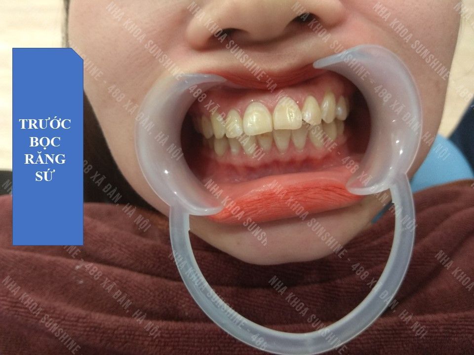 Chị Hạnh TRƯỚC VÀ SAU bọc răng sứ tại Nha khoa SunShine