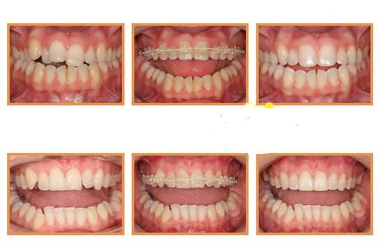 NIỀNG RĂNG MẮC CÀI SỨ LÀ GÌ