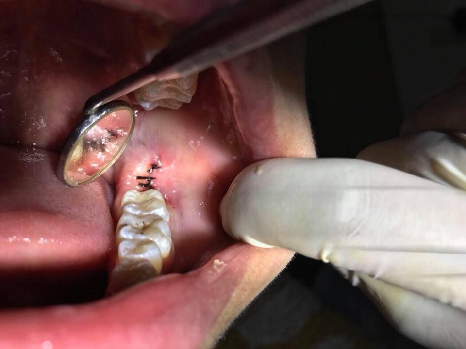 NHỔ RĂNG SỐ 8 KHÔNG ĐAU, KHÔNG PHẢI NGHỈ DƯỠNG, VỎN VẸN CHỈ TRONG 30’