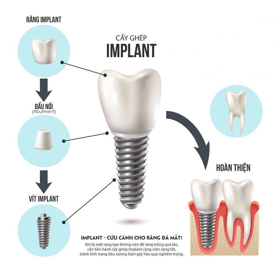 CẤY GHÉP IMPLANT - GIẢI PHÁP HOÀN HẢO CHO NGƯỜI BỊ MẤT RĂNG