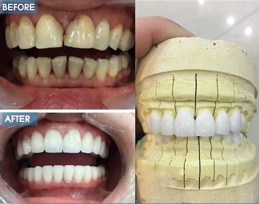 NHỮNG TRƯỜNG HỢP CẦN THIẾT PHẢ BỌC RĂNG SỨ.