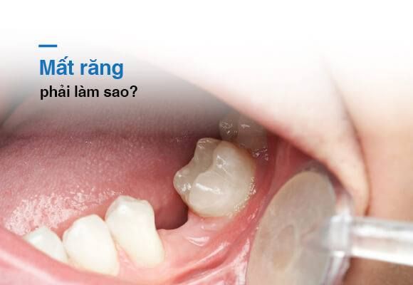 ĐIỀU GÌ SẼ XẢY RA KHI CHÚNG TA MẤT RĂNG?