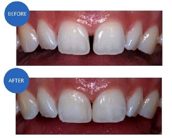 RĂNG CỬA BỊ THƯA THÌ PHẢI LÀM SAO