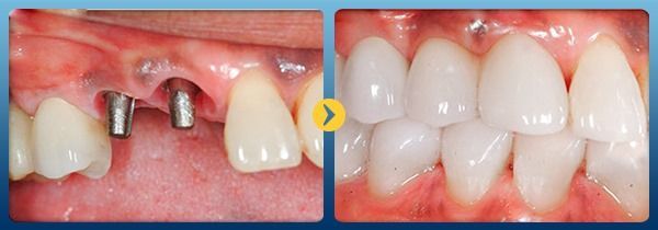 VÌ SAO MẤT 3 RĂNG LIỀN KỀ CHỈ CẦN CẤY 2 TRỤ IMPLANT