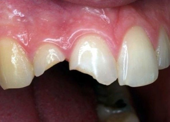 RĂNG CỬA BỊ GÃY THÌ LÀM SAO