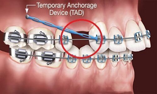NHỔ RĂNG KHI NIỀNG - NỖI TRĂN TRỞ ĐƯỢC NHA KHOA GỠ RỐI.