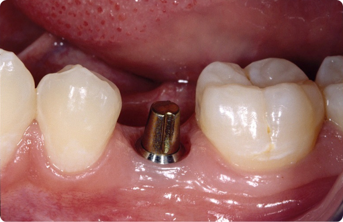 TRỒNG RĂNG IMPLANT LÀ GÌ?