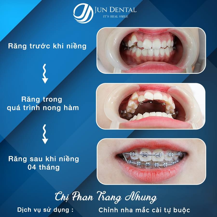 Tiến triển sau 06 tháng thực hiện niềng răng của bạn Phan Trang Nhung