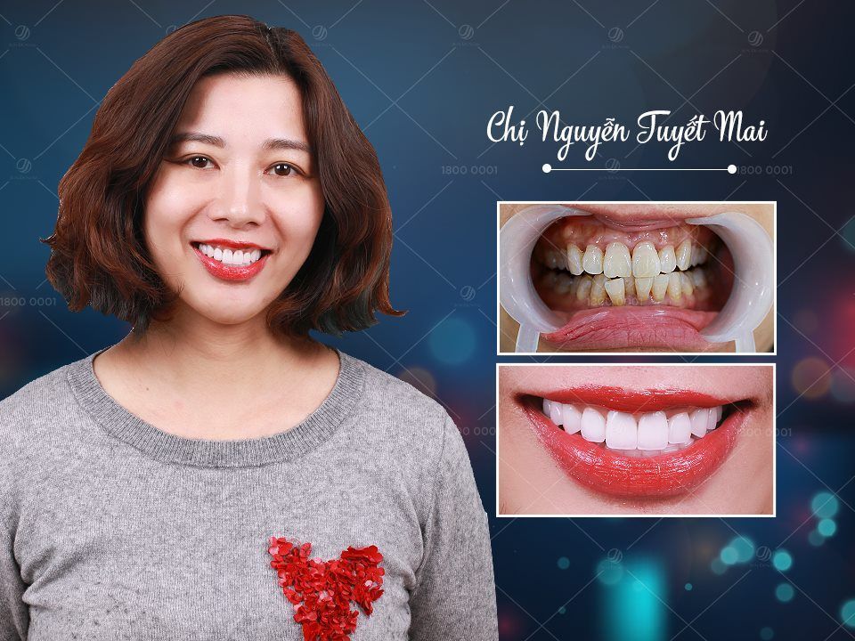 Hình ảnh chị Nguyễn Tuyết Mai trước và sau khi làm răng sứ thẩm mỹ tại Jun Dental nhằm loại bỏ hoàn toàn các khuyết điểm, nhưng vẫn bảo tồn răng gốc và ăn nhai tốt như: