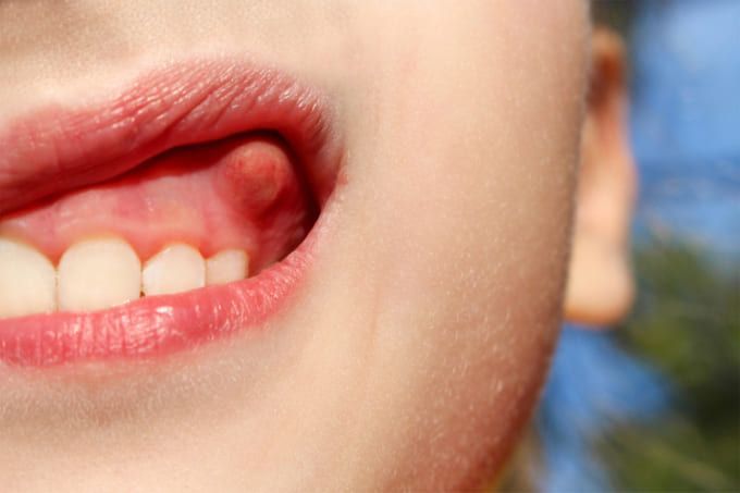 Bệnh áp xe răng là do biến chứng của việc nhiễm trùng răng miệng, vi khuẩn từ các mảng bám có trên răng gây ra mủ chân răng hay nướu răng