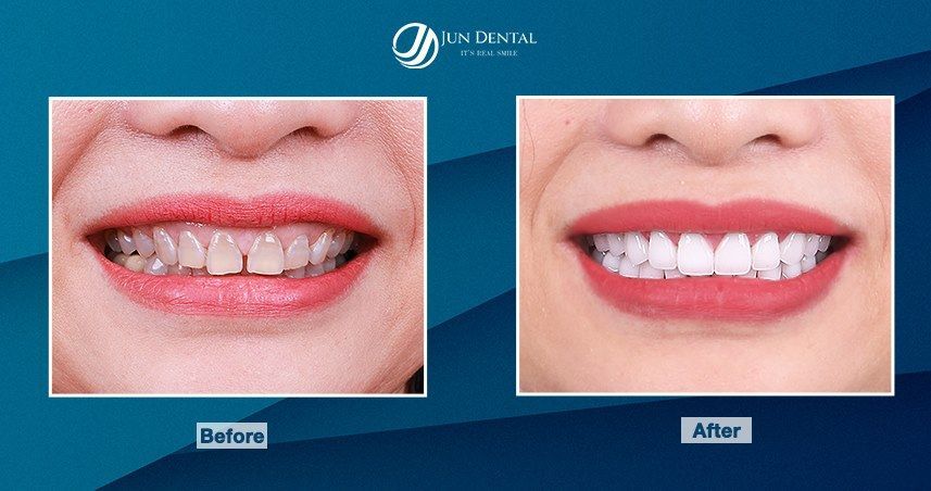 Sự thay đổi bất ngờ hàm răng của chị Hoàng Thị Ngọc Anh - Việt Kiều Đức, trước và sau khi thực hiện Combo dịch vụ chữa cười hở lợi nâng khớp cắn  răng sứ thẩm mỹ tại Jun Dental.