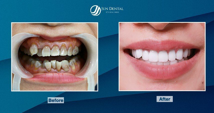Với răng nhiễm Tetracyline - màu xanh đen hoặc xám xanh đã ăn sâu trong cấu trúc răng, thì sử dụng các phương pháp tẩy trắng răng thông thường sẽ không đem lại hiệu quả