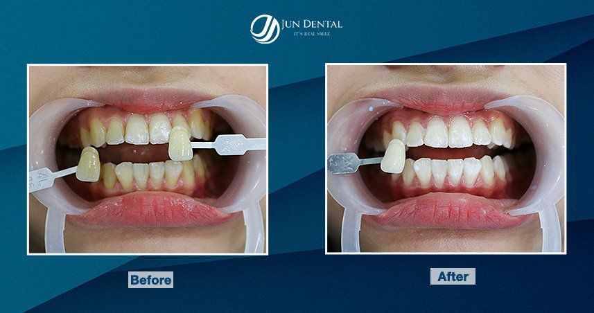Hình ảnh Khách hàng trước và sau khi tẩy trắng răng Super Poririn tại Nha Khoa Thẩm Mỹ Quốc Tế Jun Dental. Màu sắc răng trắng bóng tự nhiên hẳn 05 tông.