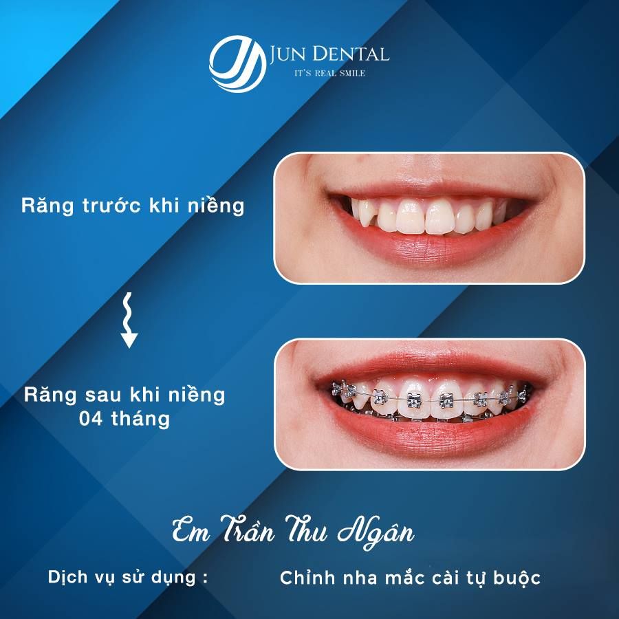 Tiến triển sau 04 tháng thực hiện niềng răng của bạn Trần Thu Ngân - 19 tuổi tại Jun Dental.