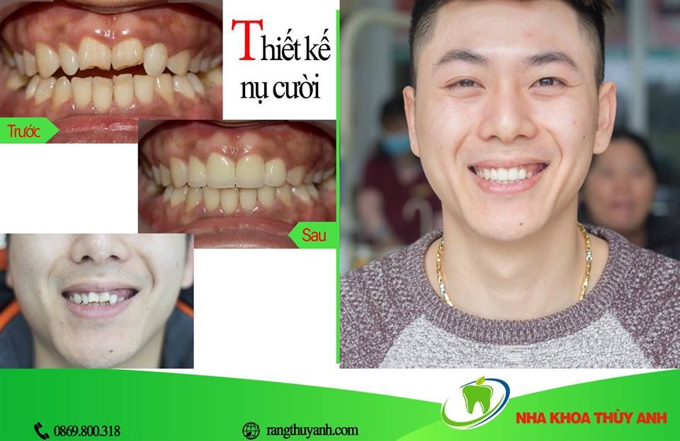 Bọc răng sứ giảm giá SỐC chỉ còn 1.500.000đ/ răng áp dụng đến hết ngày 15/08/2019 tại Nha Khoa Thùy Anh.