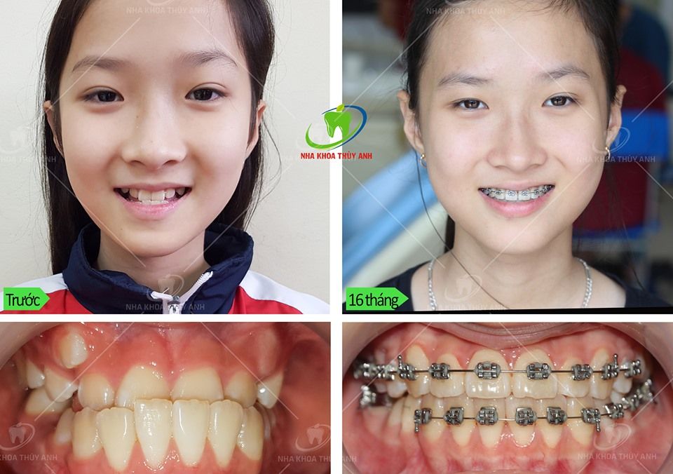 NIỀNG RĂNG TẠI NHA KHOA THÙY ANH - NHAN SẮC THẮNG HẠNG